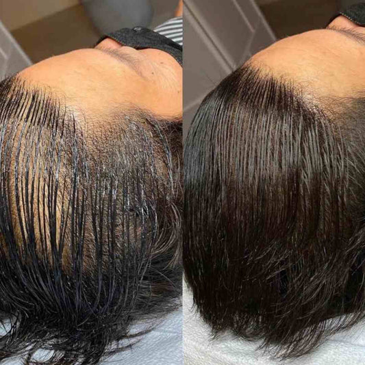 Before & After Scalp Micropigmentation at SKN Deep Cosmetic Clinic, Grimsby Ontario