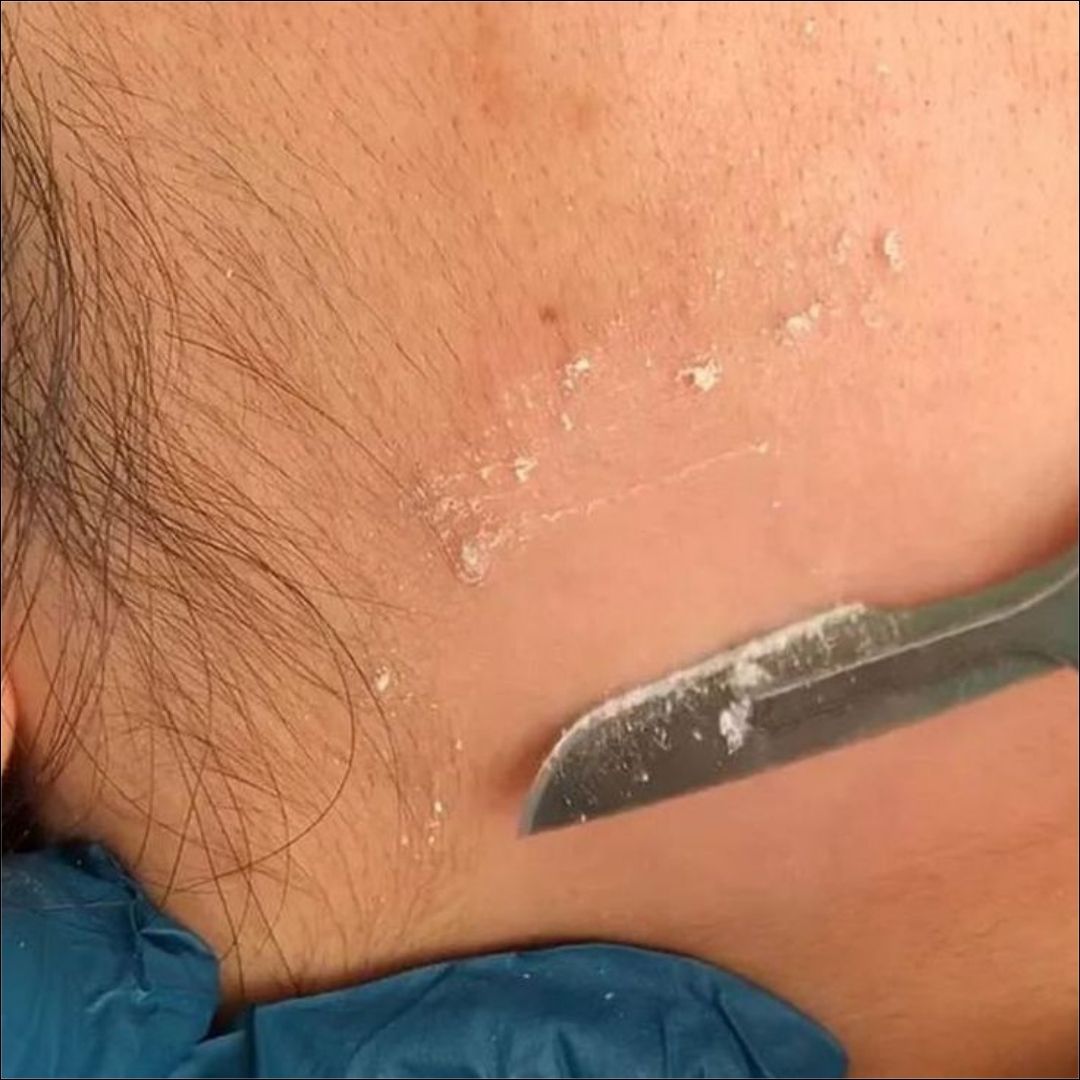 Close-up of a dermaplaning treatment in progress, showing a scalpel gently removing dead skin cells and peach fuzz from a client’s face.