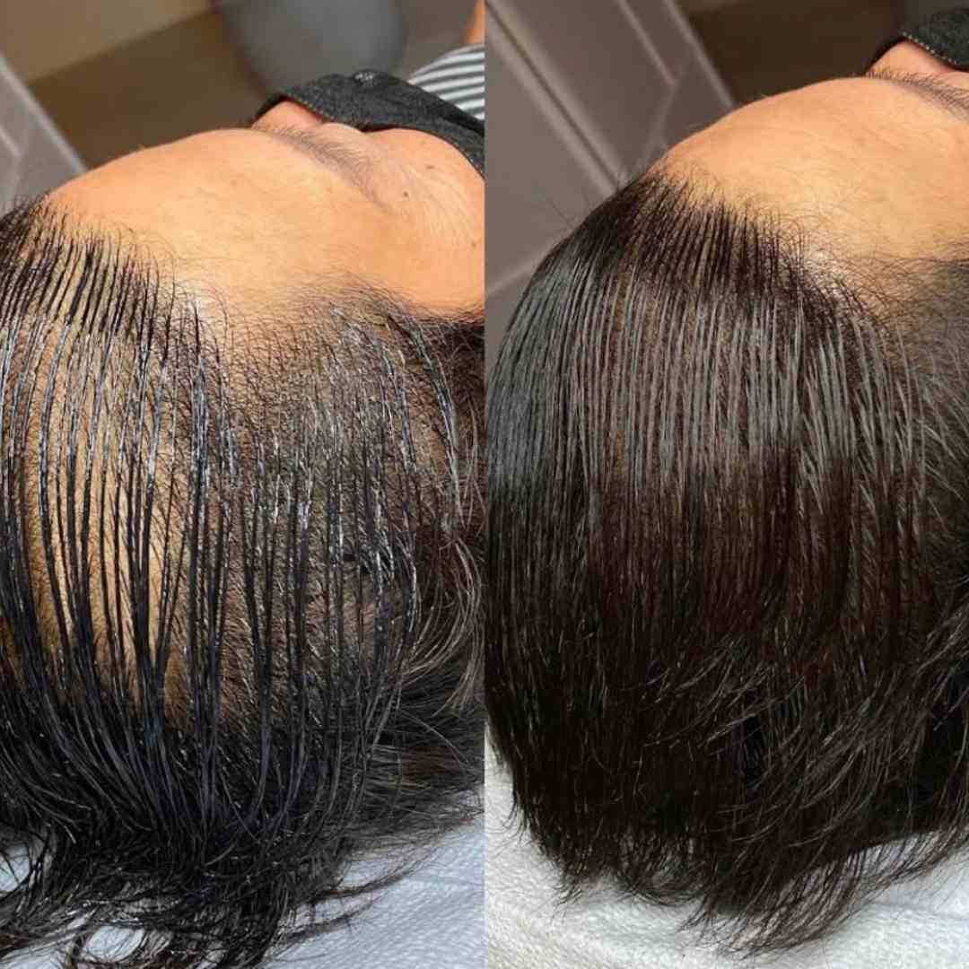 Before and after results of scalp micropigmentation tattoo on long, thinning hair in Grimsby, showing natural density restoration for thinning hair and bald spots.