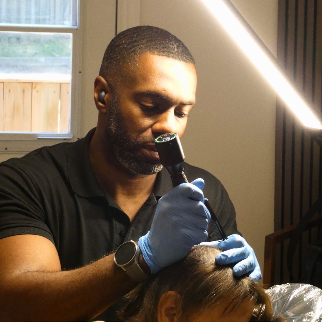 Close-up of scalp micropigmentation tattoo procedure on female client at SKN Deep clinic, showing precision technique for natural hair restoration.