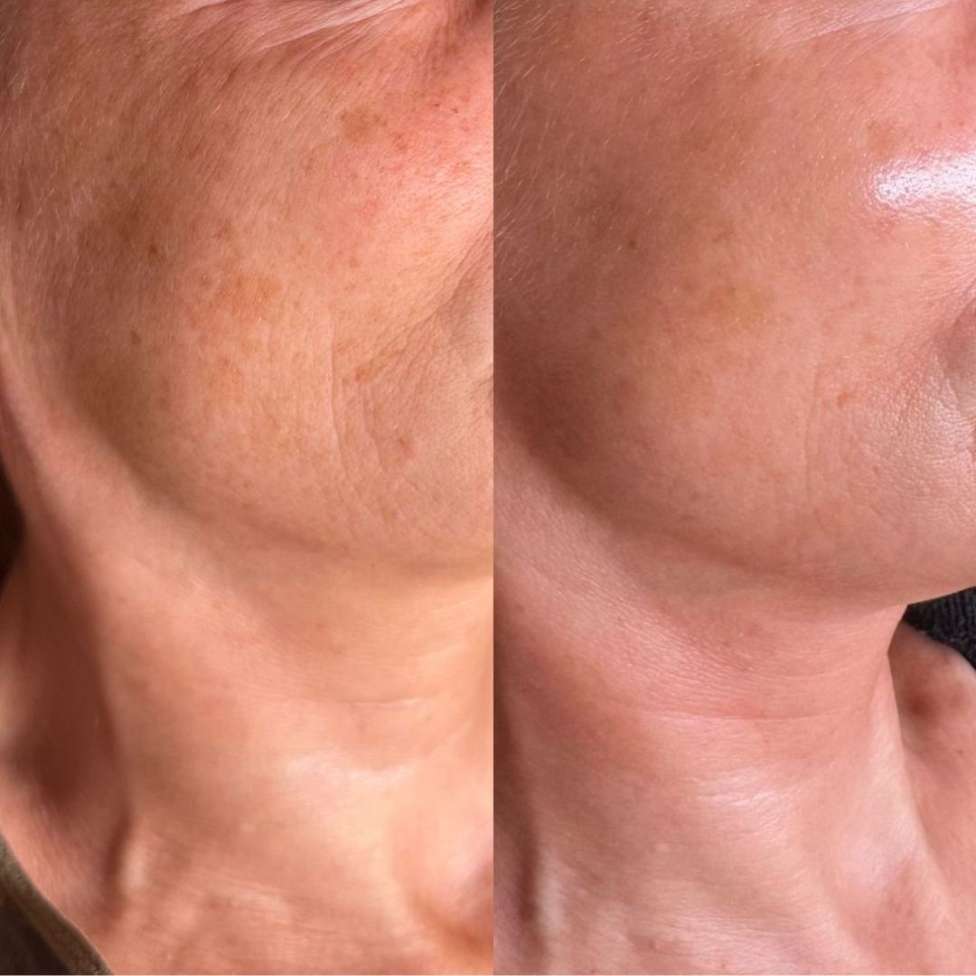 Before and after of diamond microdermabrasion on mature skin showing reduced pigmentation, smoother texture, and a brighter tone.