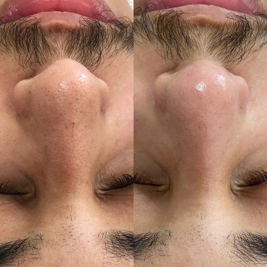 GRIMSBY'S CERTIFIED DIAMOND MICRODERMABRASION FACIAL