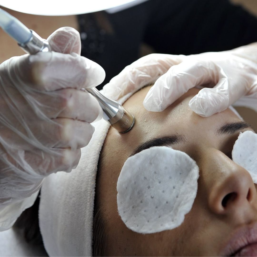 Diamond-tip microdermabrasion facial in progress under magnifying lamp, performed by skincare specialist.
