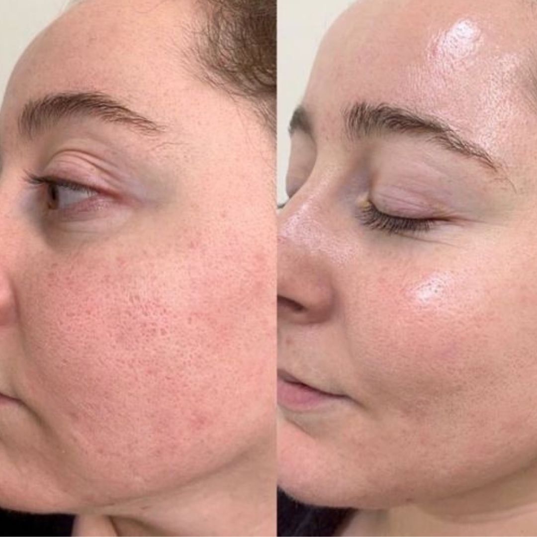 Before and after microneedling results showing smoother texture, less redness, refined pores, and glowing skin after treatment.