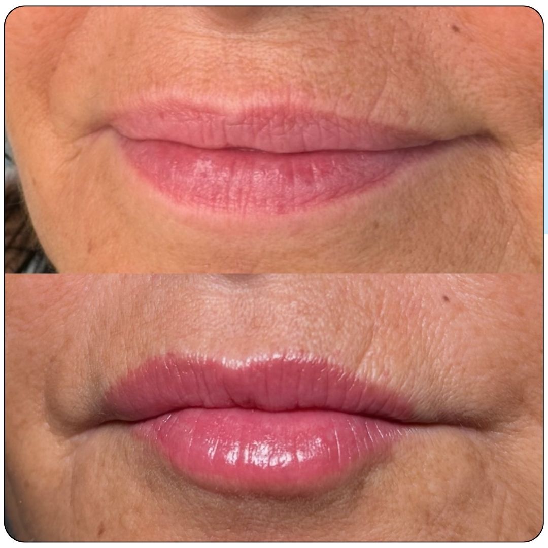 Close-up before and after transformation of a lip blush procedure at SKN Deep Cosmetic Clinic. This cosmetic tattooing service provides a soft, tinted effect for naturally defined and beautifully pigmented lips.