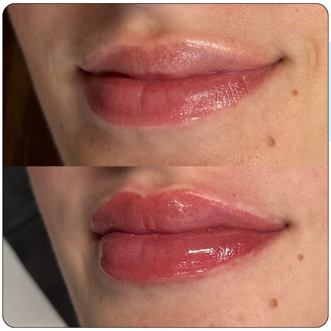 Permanent Lip blush tattoo at SKN Deep Cosmetic Clinic in Grimsby, Ontario. A semi-permanent lip pigmentation procedure designed to enhance natural lip color, add definition, and improve overall lip symmetry for a youthful, fuller appearance.