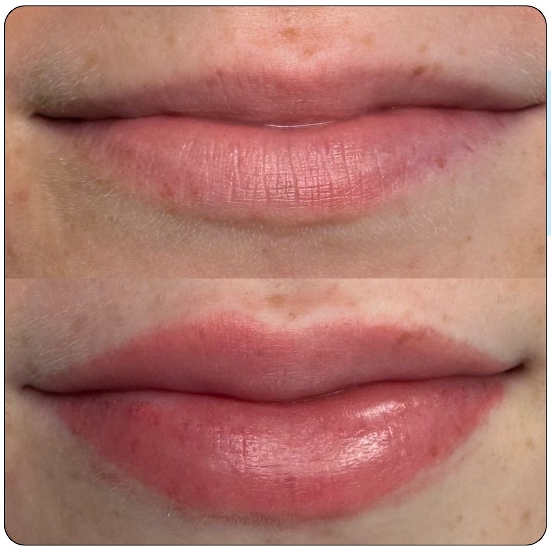 Before and after results of a lip blush treatment at SKN Deep Cosmetic Clinic in Grimsby, Ontario. This semi-permanent makeup enhances lip color, corrects uneven tones, and defines the natural lip shape. Ideal for achieving soft, natural-looking lip color with long-lasting results.