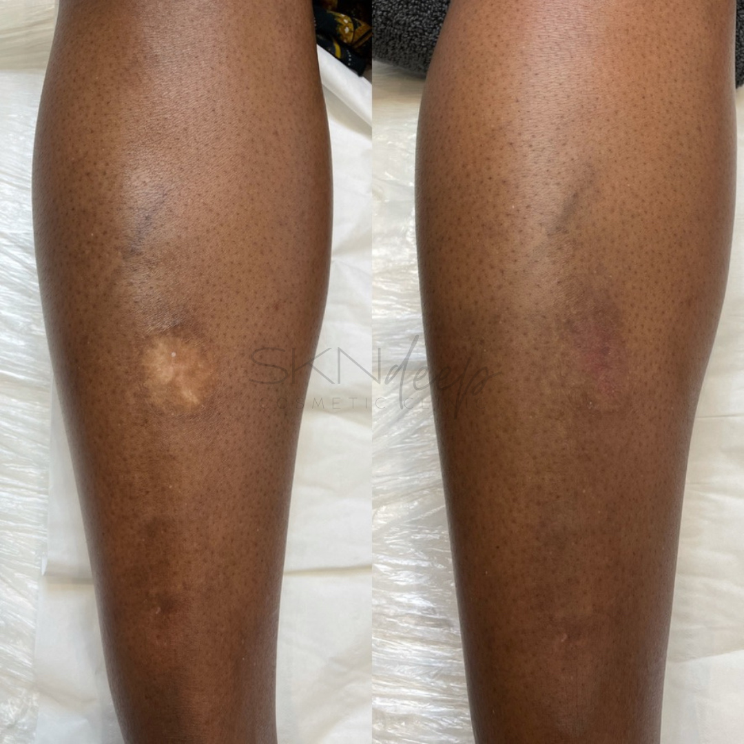 SKN Deep Cosmetic Clinic Scar Service - before and after picture of scar camouflage