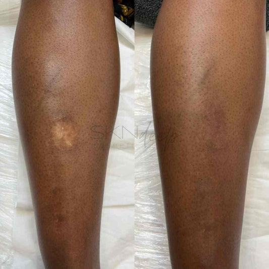 Before & After Scar Camouflage at SKN Deep Cosmetic Clinic, Grimsby Ontario