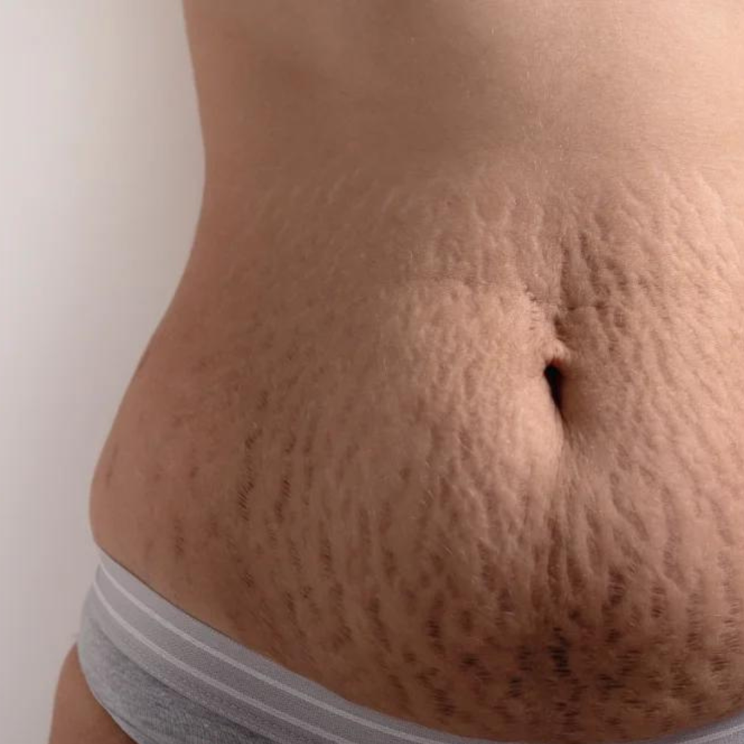 SKN Deep Cosmetic Clinic Stretch Marks Product Page - picture of post pregnancy stretch marks on woman's stomach