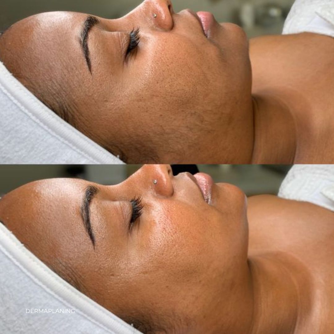 Before and after comparison of a person's face with visible skin texture changes.
