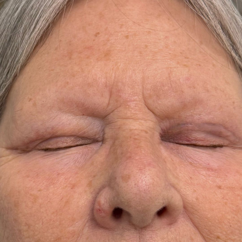 Before - Combo brow for hair loss