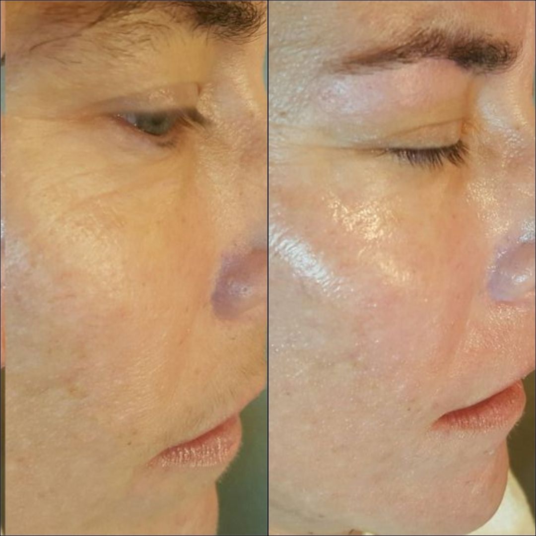 Before and after dermaplaning facial showing smoother, brighter skin with reduced peach fuzz and improved texture after gentle exfoliation treatment.