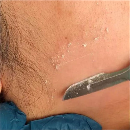 Close-up of a dermaplaning treatment in progress, showing a scalpel gently removing dead skin cells and peach fuzz from a client’s face.