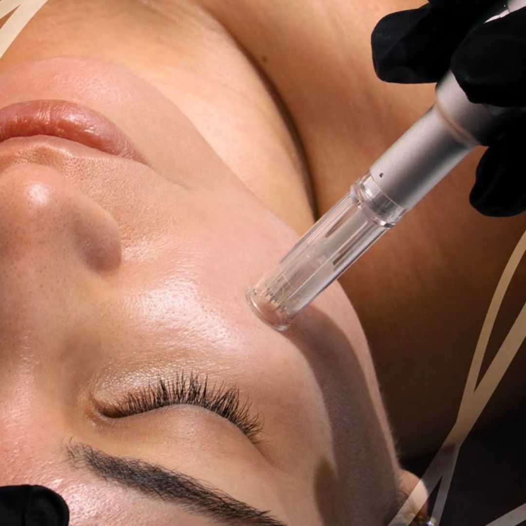 Close-up of a person receiving a skin treatment with a handheld device.