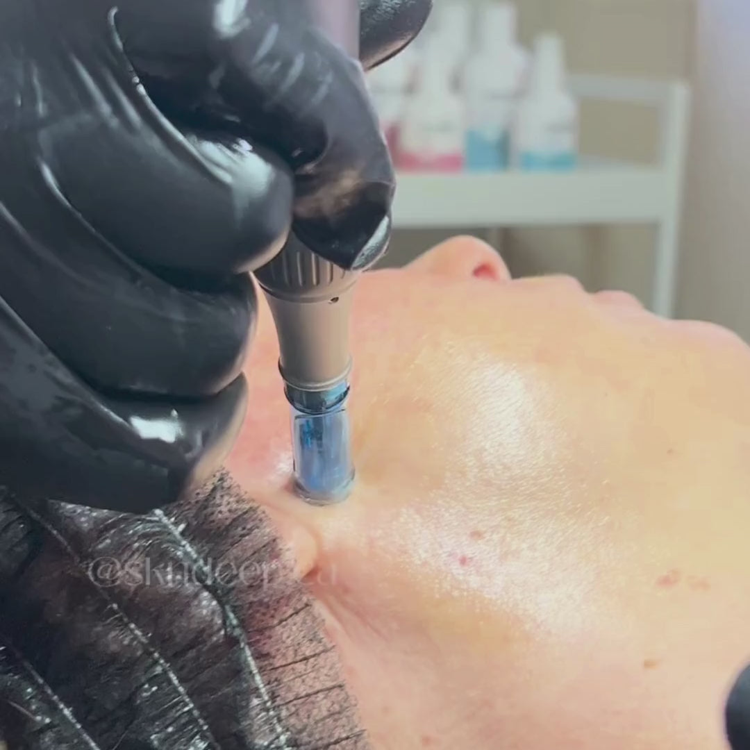 Certified skin specialist performing microneedling treatment at SKN Deep Clinic in Grimsby to improve texture and boost collagen production.