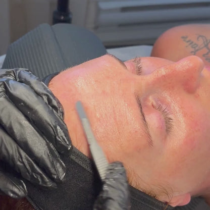 Close‑up of dermaplaning facial treatment using a sterile blade to gently remove dead skin and peach fuzz, revealing smoother, brighter skin during exfoliation.