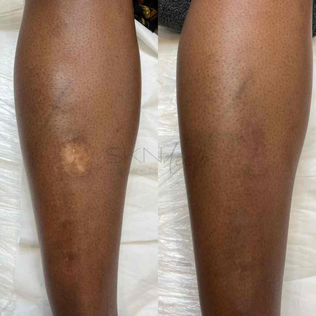 Before and after results of scar camouflage tattoo on a dark-skinned leg after 3 sessions. The light scar is blended into the natural skin tone at SKN Deep Cosmetic Clinic.