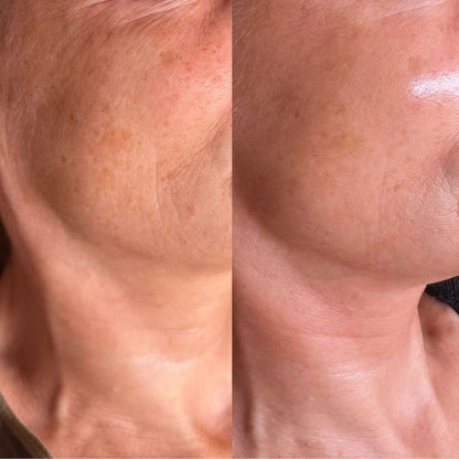 Before and after of diamond microdermabrasion on mature skin showing reduced pigmentation, smoother texture, and a brighter tone.