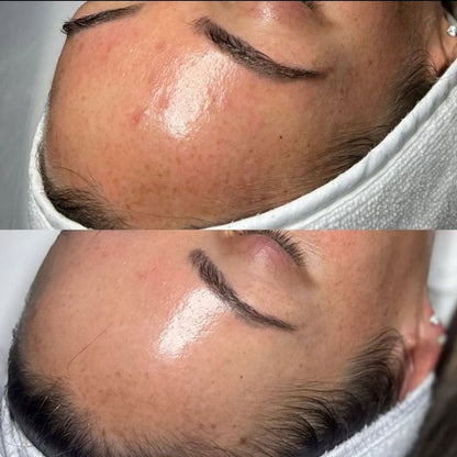 Before and after microneedling on forehead showing smoother texture, reduced redness, and glowing skin after facial rejuvenation.