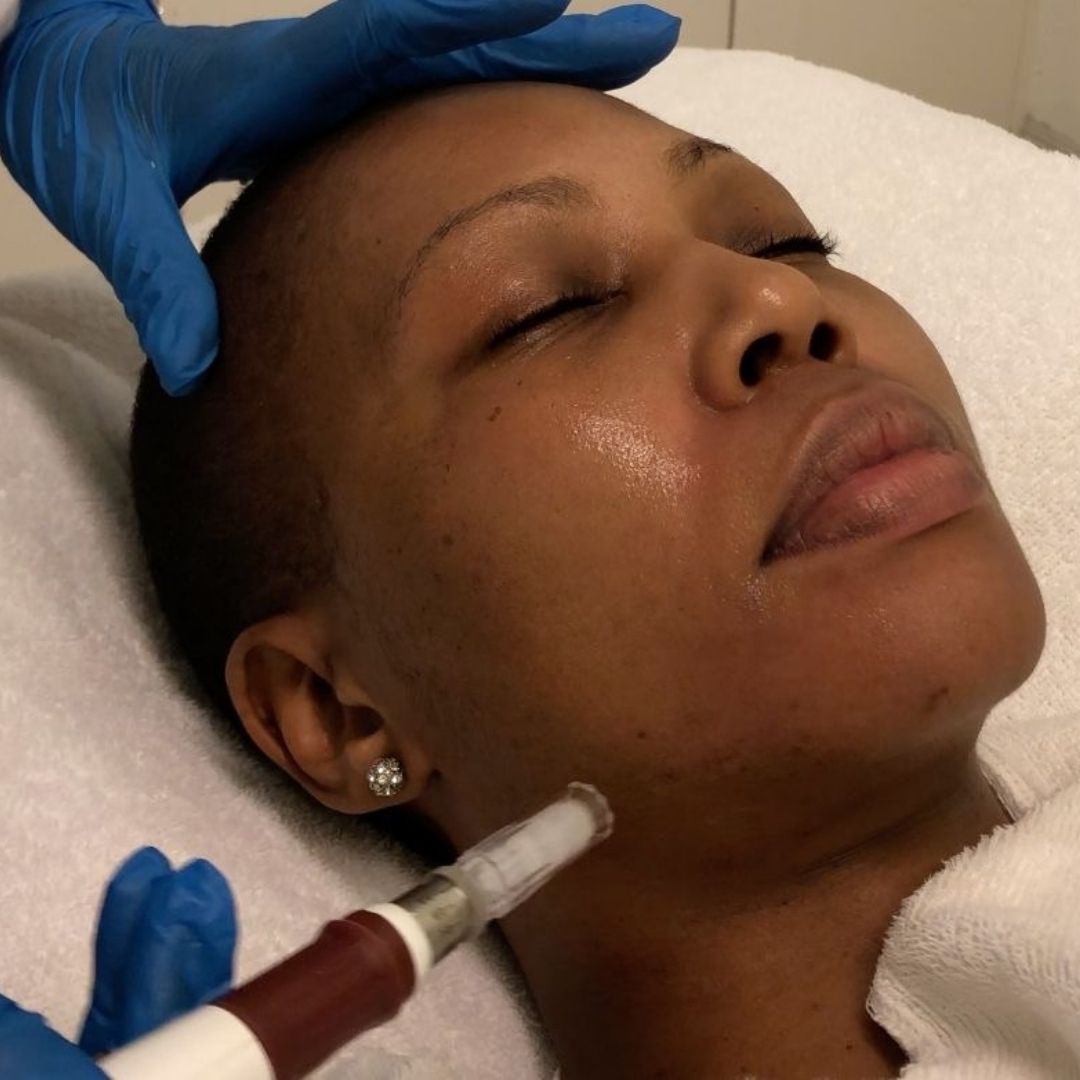 Certified skin specialist performing microneedling treatment on healthy, deeper-toned skin.