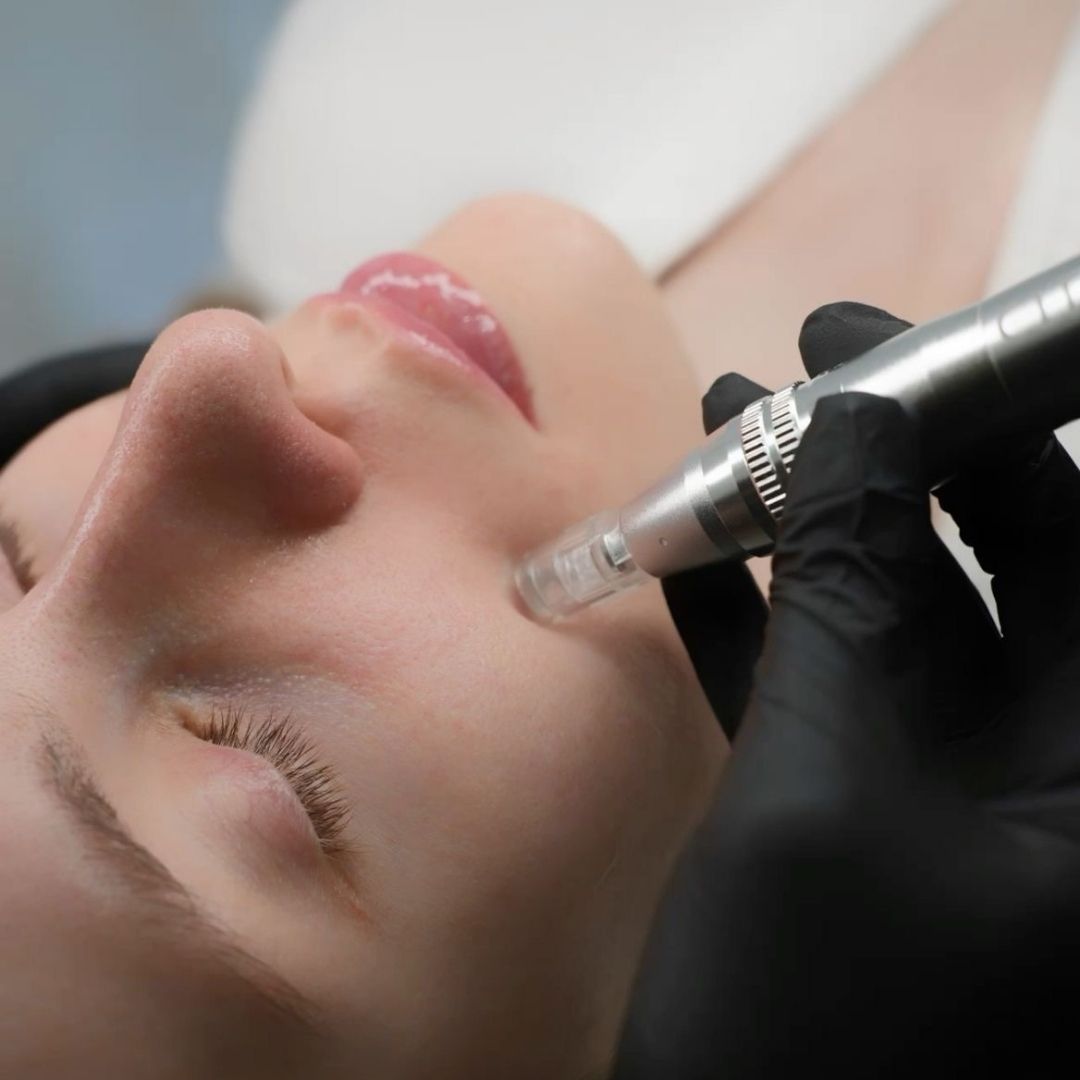 Close-up of woman receiving professional microneedling treatment on cheek using a precision device to boost collagen and rejuvenate skin