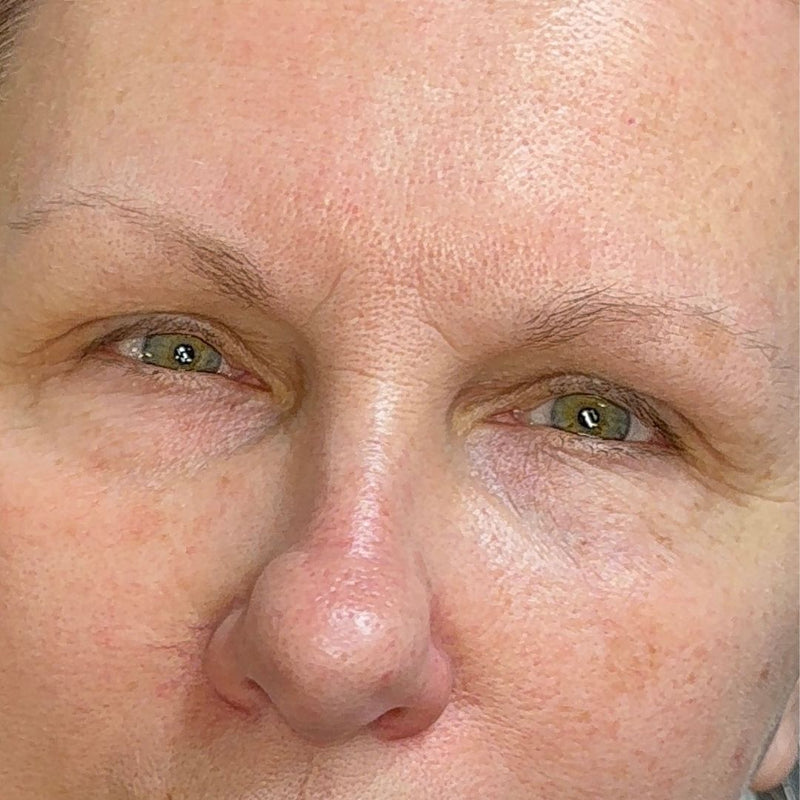 Close-up of a person's face showing the sparse brows before getting nano brow service performed at SKN Deep Cosmetic Clinic in Grimsby.