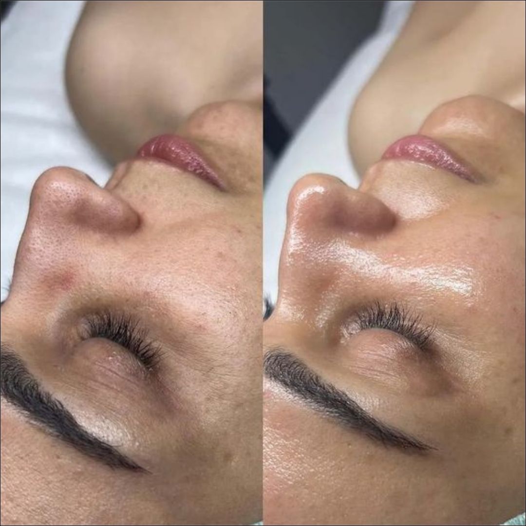 Side-by-side comparison of a client’s face showing the transformative results of a TCA chemical peel. The left side shows dull skin with visible pores, while the right side features smooth, glowing, and radiant skin after treatment at a beauty cosmetic clinic.